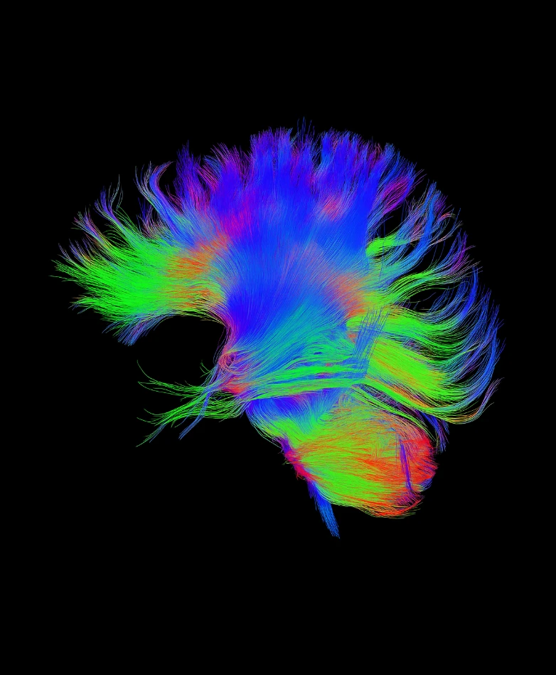 DTI Brain Scan MARC Orlando