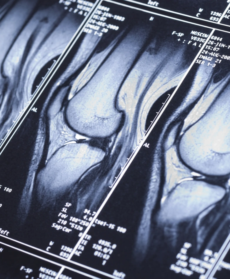 Ligament MRI Scan