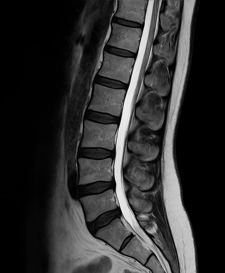 MRI Spine Scan MARC Orlando