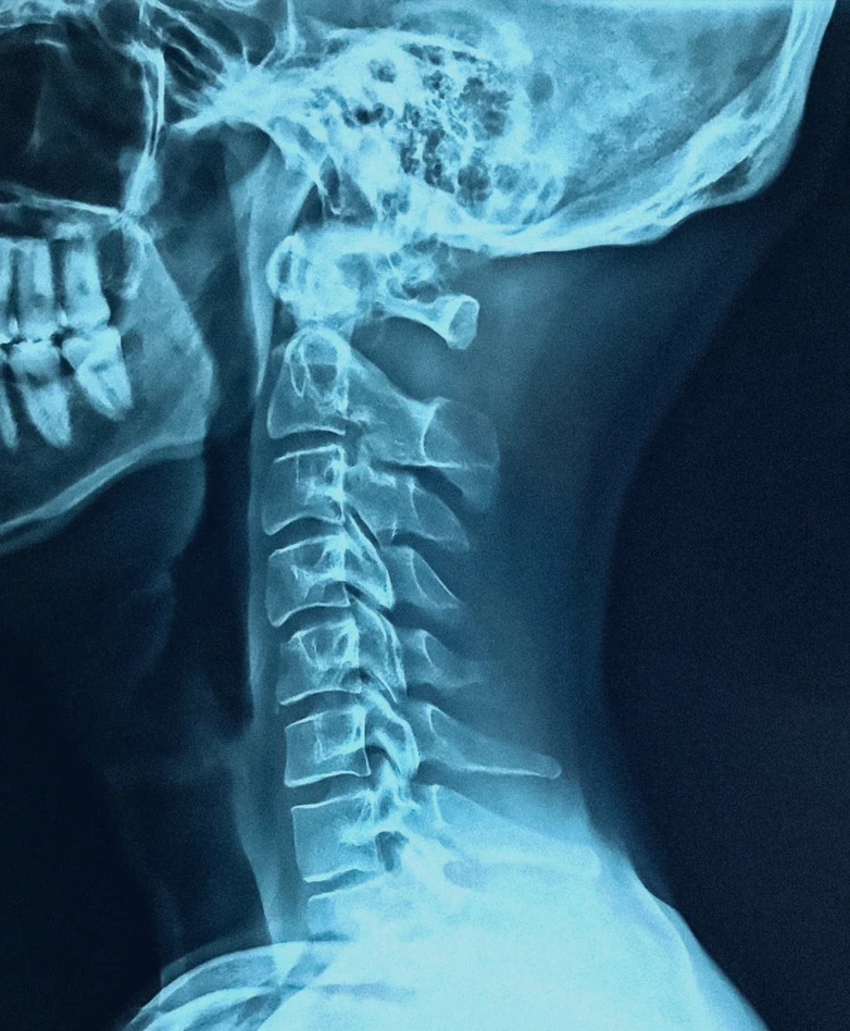 Spine Neck X Rays Chronic Pain